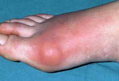 Gout most commonly occurs as a recurrent attack of acute inflammatory arthritis, most commonly affecting the metatarsal-phalangeal joint at the base of the big toe (50% of cases).