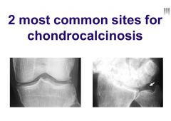 Most common sites for chondrocalcinosis are within the knee and the wrist
Can see calcification particularly within the menisci in the knee