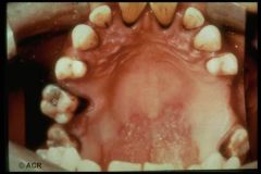 Erosion of the hard palate is the most common oral manifestation of reactive arthritis.
(Can also get oral ulcers.)