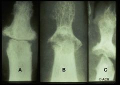 Which seronegative spondylarthropathy is associated with the pencil-in-a-cup radiographic finding?