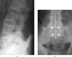 Which seronegative spondylarthropathy is associated with the “dagger” radiographic finding?