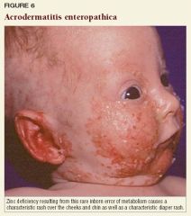 Acrodermatitis enteropathica; the rare disorder is characterized by a particular pustular rash associated with anglular cheilitis, diarrhea, alopecia, and immunodeficiency.