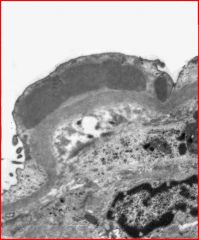 Large dark subepithelial humps on electron microscopy