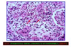 Interstitial edema and influx of eosinophils