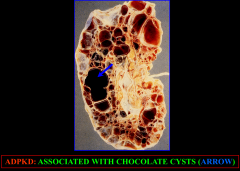 ADPKD: Sometimes the cyst presses on an intrarenal blood vessel so much that it ruptures, and the blood goes into the cystic cavity and becomes coagulated, and when you make a cut section, all you see is the clotted blood, which they call the chocolate cy