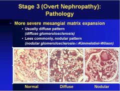 Kimmelstiel-Wilson – nodular glomerulosclerosis  (sign of stage 3 diabetic nephropathy)