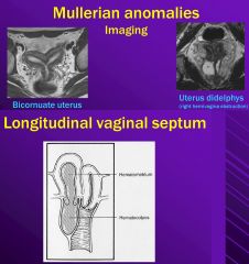 Longitudinal septum
(or Uterus didelphys)