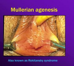 Rokitansky syndrome, or mullerian agenesis, is an absence of the uterus, cervix, and upper vagina. It’s the second most common cause of primary amenorrhea after gonadal failure. The women are not capable of carrying their own offspring, but they could hav