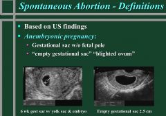An anembryonic abortion is an abortion where the gestational sac is present but no fetal pole can be identified on ultrasound exam.