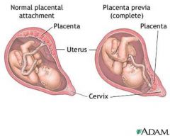 Placental previa is when the placenta covers the cervical os.