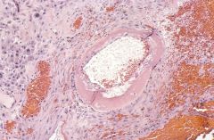 Fibrinoid necrosis with acute atherosis is characteristic of what pathologic phenomenon ?
