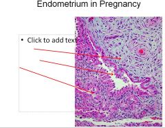 What is the name for the “reaction” that mimics carcinoma in the endometrium during pregnancy (3rd arrow)?