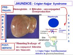 Crigler-Najjar syndrome is a disorder where there’s a mutant defect in the glucuronyltransfersase, which is responsible for transporting unconjugated bilirubin so that it can be conjugated into direct bilirubin. This causes jaundice and the accumulation o