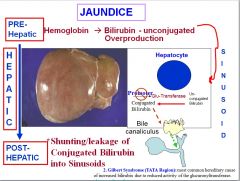 In Gilbert syndrome, the promoter region for the Glu-Transferase is affected, reducing the efficacy of the gene and thus causing jaundice and a buildup of unconjugated bilirubin.