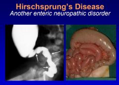 Hirschsprung's disease is a congenital, genetic disorder whose etiopathogenesis involves the failed migration of neural crest cells in the distal hindgut. The absence of enteric neurons (nitric oxide neurons) results in tonic contraction of the distal rec