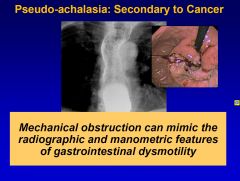 Pseudo-achalasia is achalasia secondary to cancer. That is why you should always check for mechanical obstruction, which can mimic radiographic and manometric features of GI dysmotility, in suspected achalasia patients.