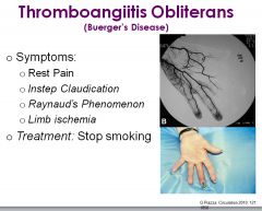 •	Thromboangiitis Obliterans (Buerger’s disease)
•	Medium-small arteries
•	Can involve nerve and vein
•	Very segmental
•	Tibial and radial arteries most involved
•	Symptoms
o	Rest Pain
o	Instep claudication
o	Raynaud’s phenomenon
o	Limb ischemia
