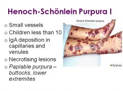 •	Henoch-Schonlein Purpura
•	Small vessels
•	Children less than 10
•	IgA deposition in capillaries and venules
•	Necrotising lesions
•	Paplable purpura – buttocks, lower extremites
•	Other symptoms
o	Polyarthralgia w/o arthritis
o	Abdominal pain
