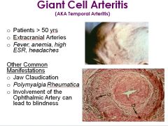Giant cell arteritis; treat with steroids, which are the mainstay of treatment for temporal arteritis.