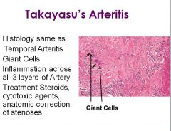 •	Takayasu’s Arteritis; associated with Asian women < 50
•	Constitutional symptoms
•	Involves ascending aorta and immediate branches
•	“Pulseless disease”