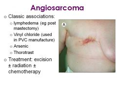 Angiosarcoma (exposure to chemicals such as arsenic or vinyl chloride)