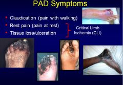 •	Claudication (pain with walking)
•	Rest pain (pain at rest)
•	Tissue loss/ulceration
