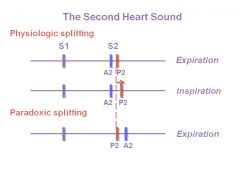 •	Paradoxic splitting can occur with aortic stenosis, and P2 occurs before A2 due to delayed emptying of the LV.
•	The pulmonic valve is working normally and moves to the right temporally as it should, but since A2 is on the wrong side, you get narrowing