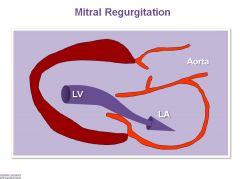 C) Mitral regurgitation does not cause LVH, because it does not increase afterload. Afterload is what causes the muscle to hypertrophy. As soon as the ventricle wants to shorten during MR, it sees an out (a way to relieve its pressure, and thus there’s no