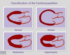 •	Conditions that cause infiltrative processes in myocardium are the most common causes
o	Amyloidosis
o	Hemochromatosis
o	Sarcoidosis
o	Etc
•	Thickening and stiffening of ventricular myocardium
o	Results in restriction of ventricular filling
o	Redu
