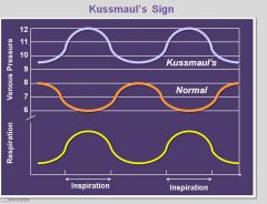 •	Kussmaul’s sign
o	Increase in venous pressures in the neck on inspiration as opposed to expiration
•	Jugular venous distention
•	Pericardial knock