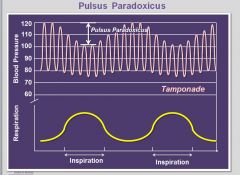 Pulsus paradoxus occurs in cardiac tamponade and reflects exaggerated decreased systolic and diastolic pressures during inspiration.