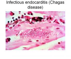 An important parasitic cause of myocarditis is by Trypanosoma cruzi, transmitted by the reduviid bug (which harbors the parasite in its feces). About 20M people in South America are affected with T. cruzi.