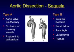 Type A involves the ascending  aortic arch, and type B doesn’t.
•	50-60 years of age – Type A
•	60-70 years of age – Type B