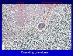 Caseating granulomas