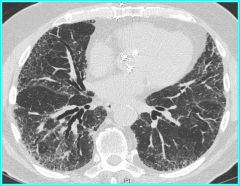 What is this CT finding indicative (hint: it’s an interstitial lung disease)?