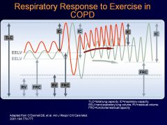 With each successive breath, more and more air gets left in the chest
Inefficient response to exercise: there’s a progressive increase in end expiratory lung volume, and there’s a progressive decrease in inspiratory capacity due to airflow obstruction (a