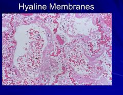 Hyaline membranes