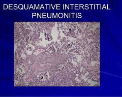 •	Smoking related
•	Morphology – accumulation of macrophages within alveolar spaces with minimal interstitial fibrosis
•	Early stage/precursor of usual interstitial pneumonitis