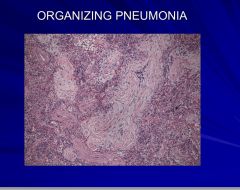 •	Infectious –viral or bacterial
•	Inflammatory – inhaled toxins, drugs, collagen vascular disease and GVHD
•	Idiopathic – cryptogenic organizing pneumonia