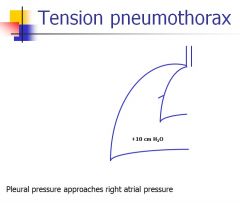 Tension pneumothorax: the pressure in the pleural space starts to approach right atrial pressure, which causes venous return to decrease/be impaired. Tension pnpeumothorax requires immediate drainage of the pleural space.