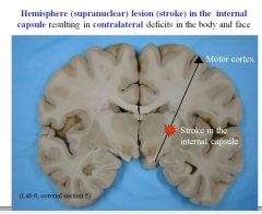 Lesion in the internal capsule results in contralateral deficits in the body and face.