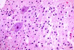 Oligodendrogliomas have fried egg appearance; they also have chicken-wire capillaries.