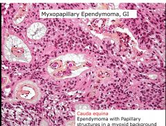 Myxopapillary Ependymoma