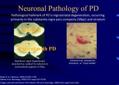 Nigrostriatal degeneration is a pathological hallmark of PD, occurring primarily in the substantia nigra pars compacta (SNpc) and striatum)
Also, Lewy bodies are a histopathological hallmark of PD