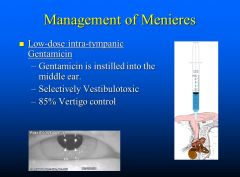 Low dose intra-tympanic gentamicin (85% vertigo control)