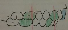 Class II, Division 2 Malocclusion

(Mandible retruded & one or more incisors are retruded)