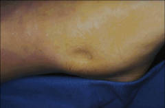 1. What are common etiologies of pitting edema?