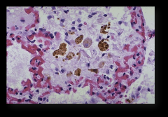 1. Chronic - Hemosiderin laden macrophages, fibrotic septa