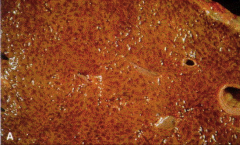 1. What is the etiology of nutmeg liver (Pictured - gross)?

2. Describe the morphology