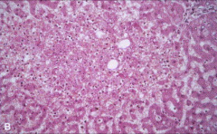 1. Right heart failure, hepatic vein or SVC obstruction

2. Central regions of hepatic lobules grossly red-brown and slightly depressed
Centrilobular necrosis microscopically (Pictured) with hepatocyte drop out and hemorrhage and fibrosis